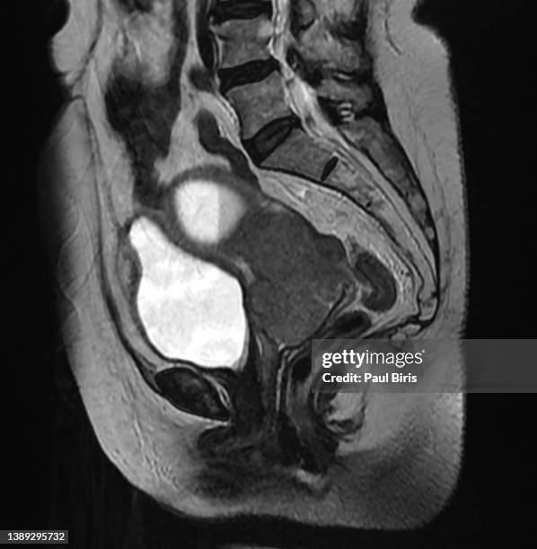 carcinoma of the cervix, magnetic resonance imaging (mri) of uterine tumor - radiotherapy stock pictures, royalty-free photos & images