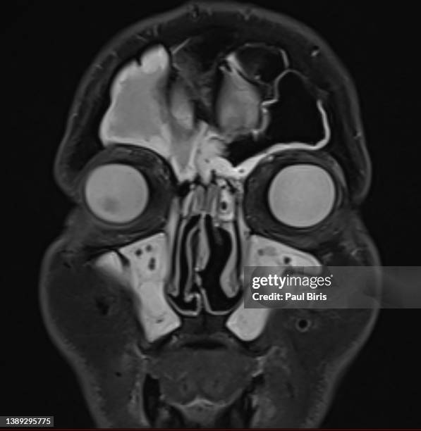 Mri Scan Sinus Machine 53 Sinus Mri Stock Photos, High-Res Pictures, and Images - Getty Images
