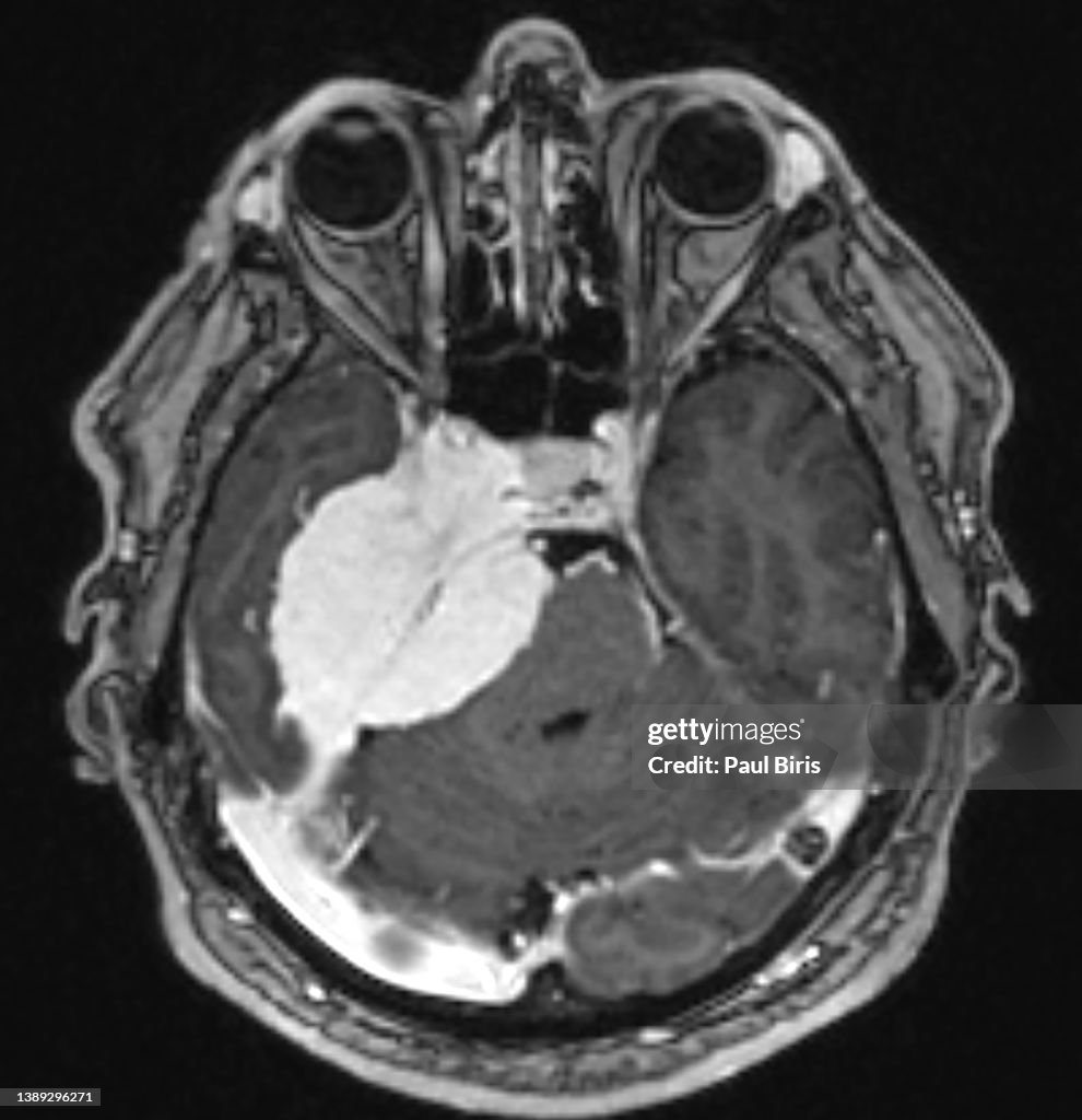 Temporal meningioma involving right temporal bone, Magnetic resonance imaging MRI, postcontrast T1 axial image