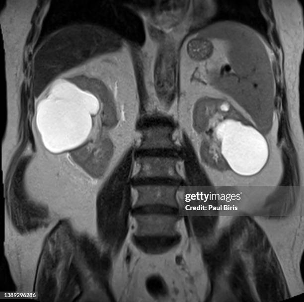 cystic renal masses seen on coronal mri t2 image - cyst stock-fotos und bilder