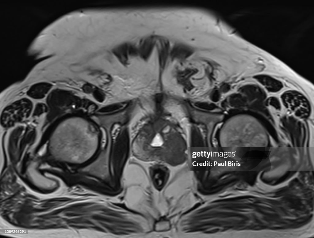 Multiparametric MR Imaging for Detection, Localization, and Staging of prostate cancer (PI-RADS)