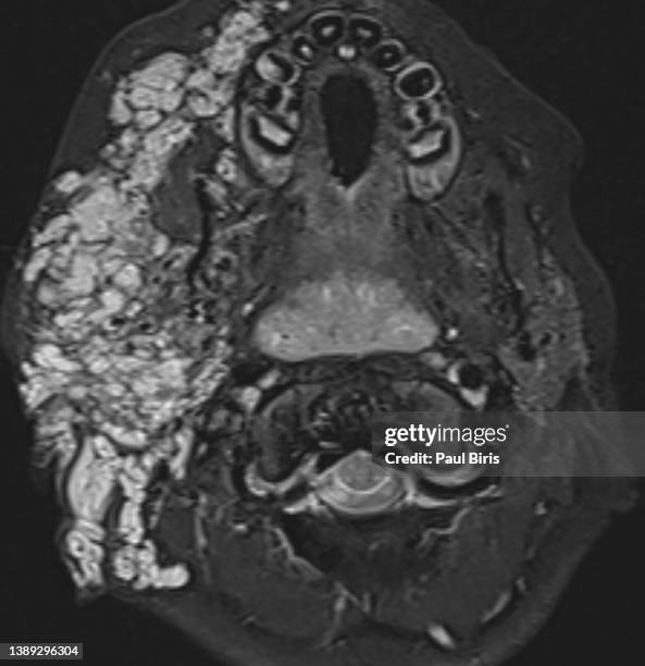 mri image  of plexiform neurofibromas in patient with neurofibromatosis type 1, axial stir image - neurofibromatose stock-fotos und bilder