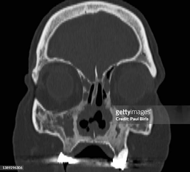 saddle nose deformity , sinonasal computed tomography in patients with wegener's granulomatosis - skull xray no brain stock pictures, royalty-free photos & images