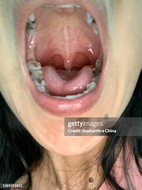 tonsilitis infection throat - rotten teeth from not brushing - fotografias e filmes do acervo