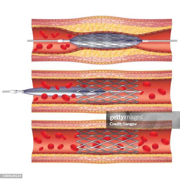 print - stent stock illustrations