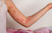 A girl with urticaria
