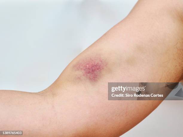 bruise on  skin - hemorrhage stock pictures, royalty-free photos & images