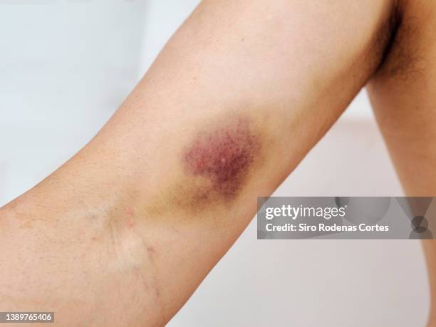 bruised arm - bruise stock pictures, royalty-free photos & images