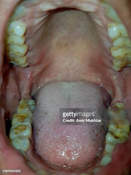 open human mouth with teeth cavity and plague. - man open mouth stock pictures, royalty-free photos & images