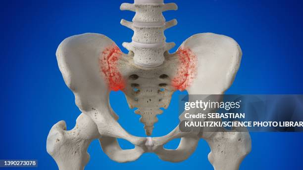 arthritic sacroiliac joint, illustration - sacrum stock illustrations
