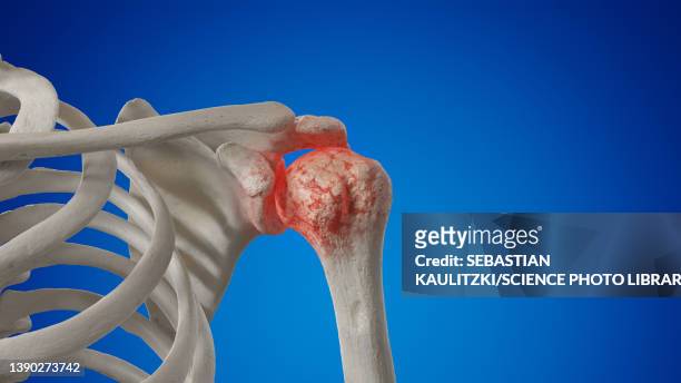 arthritic shoulder joint, illustration - rheumatismus stock-grafiken, -clipart, -cartoons und -symbole