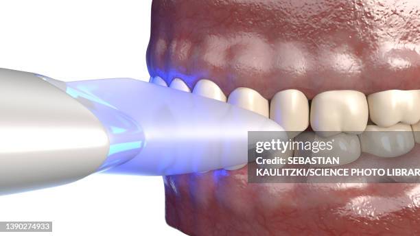 dental bleaching, illustration - bubble gum stock illustrations
