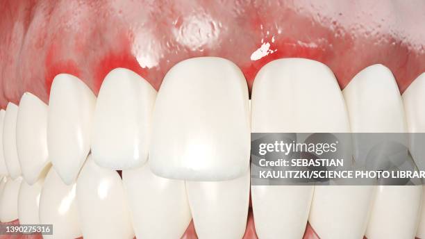 ilustrações de stock, clip art, desenhos animados e ícones de periodontal disease, illustration - periodontal