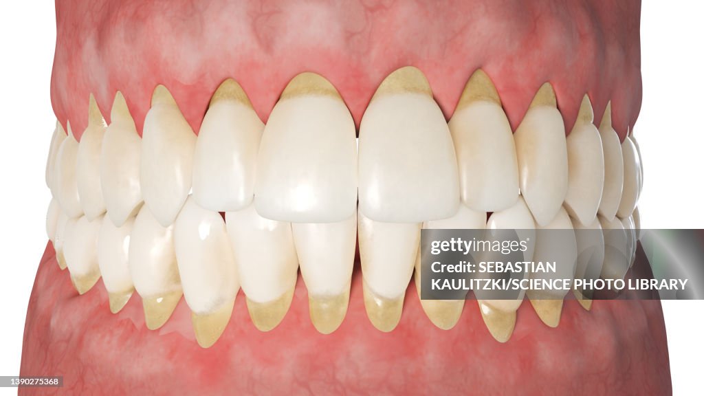 Periodontitis, illustration
