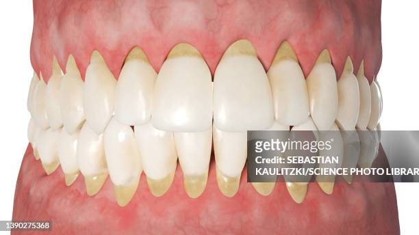 periodontitis, illustration - periodontal disease stock illustrations