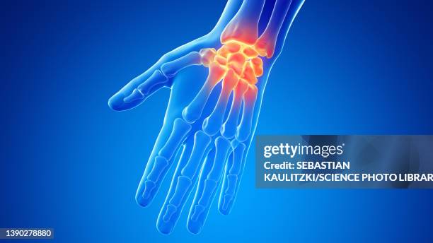 illustrazioni stock, clip art, cartoni animati e icone di tendenza di painful wrist, illustration - dito della mano