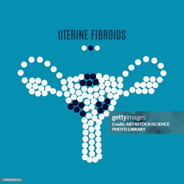 uterine fibroids, conceptual illustration - fibroids stock illustrations