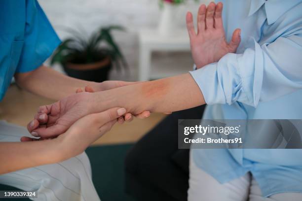 personale medico che tratta una condizione della pelle - dermatite atopica foto e immagini stock