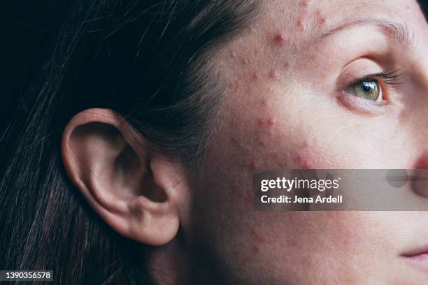 acne woman skin closeup with hormonal acne pimples - before photo - acne stock-fotos und bilder