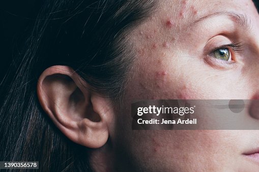Acne Woman Skin Closeup With Hormonal Acne Pimples - Before Photo Acne Woman Skin Closeup With Hormonal Acne Pimples - Before Photo
