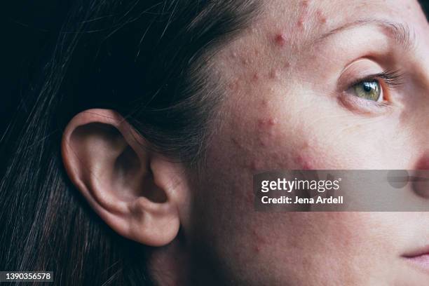 acne woman skin closeup with hormonal acne pimples - before photo - ugly woman stock pictures, royalty-free photos & images