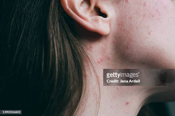 adult acne on body, pimples on neck skin problems - adult acne stock pictures, royalty-free photos & images