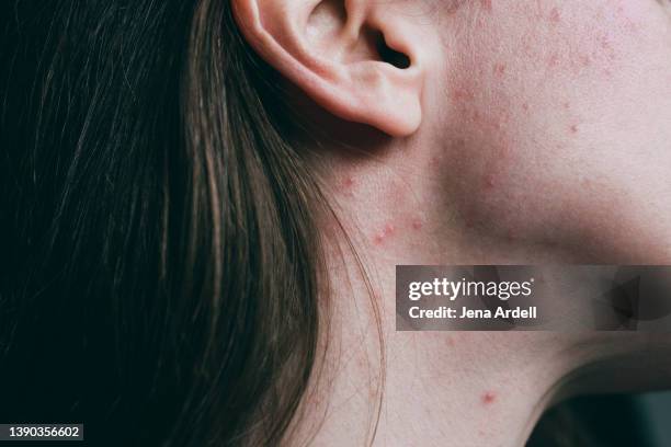 adult acne on body, pimples on neck skin problems - neck blemishes stock pictures, royalty-free photos & images