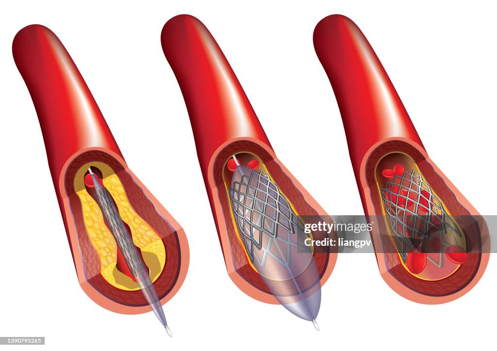 Angioplasty and Stent Placement