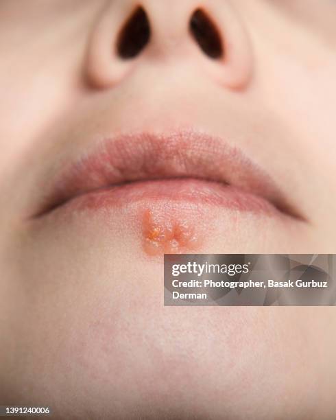 close-up photo of a woman with shallow depth of field of a big herpes simplex infection on her lower lip. - herpes labial - fotografias e filmes do acervo