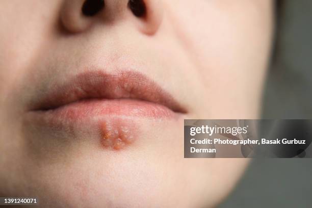 close-up photo of a woman with shallow depth of field of a big herpes simplex infection on her lower lip. - cold sore stock pictures, royalty-free photos & images