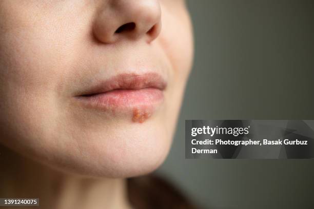 close-up photo of a woman with shallow depth of field of a big herpes simplex infection on her lower lip. - painful lips stock pictures, royalty-free photos & images