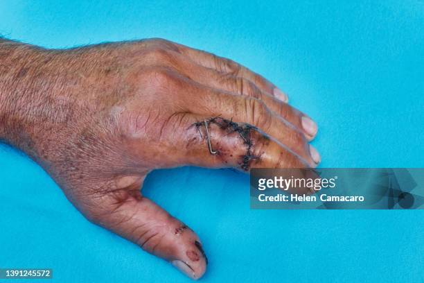 index finger with injury - bruised finger stock-fotos und bilder