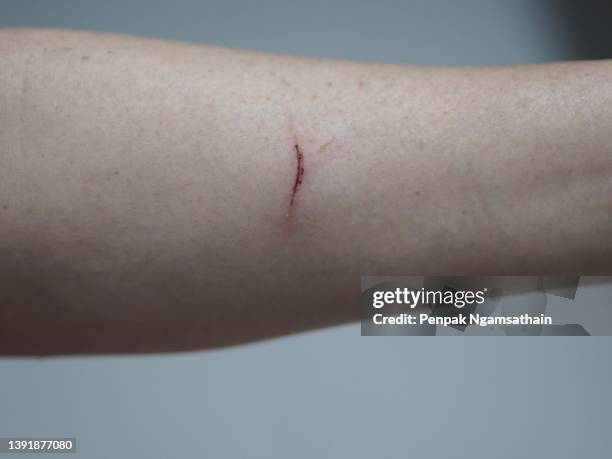 asian woman's arm was cut by a sharp object, bleeding. knife cut - hand laceration - fotografias e filmes do acervo