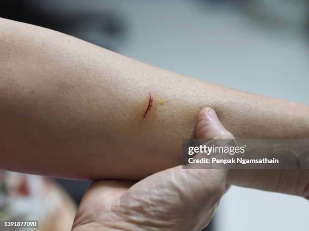 asian woman's arm was cut by a sharp object, bleeding. knife cut, lesion - hand laceration - fotografias e filmes do acervo