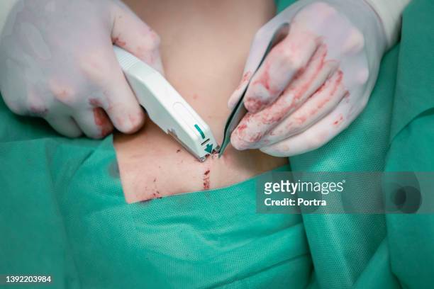 chirurgischer stich mit hauthefter nach der operation - tacler stock-fotos und bilder