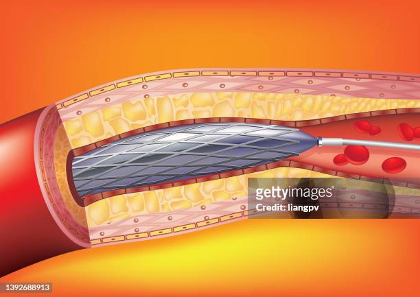 ilustraciones, imágenes clip art, dibujos animados e iconos de stock de angioplastia y colocación de stent - stent
