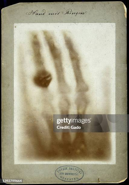 Xray image of the hand of the wife of Wilhelm Rontgen, considered one of the first radiograph images, with ring visible, 1895. Note: Image has been...