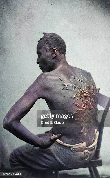 Three-quarter length view from behind of Gordon, also known as "Whipped Peter", a former enslaved man, showing, at a medical examination, keloid...