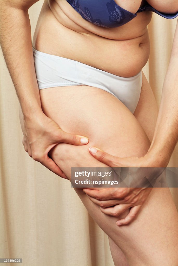 Woman showing cellulite on right thigh