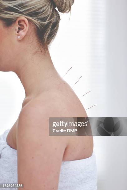 una donna irriconoscibile che ottiene aghi inseriti nella schiena durante una sessione di agopuntura. primo piano del paziente che riceve una terapia alternativa per il trattamento medico - agopuntura foto e immagini stock