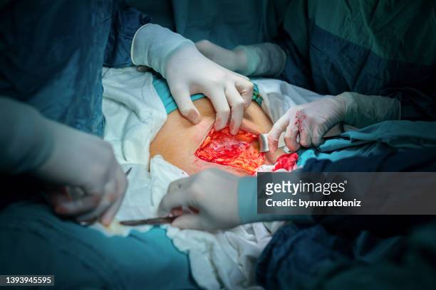 surgery in operation room - hernia stock pictures, royalty-free photos & images