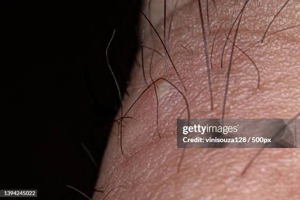 inflammation caused by ingrown hair,close-up of man with hearing aid - ingrown hair imagens e fotografias de stock