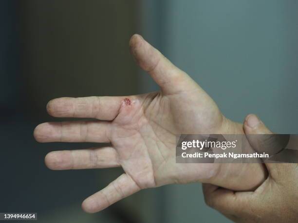 woman holding her bleeding wounds on the hand palm cut by scissors - bruised finger stock-fotos und bilder