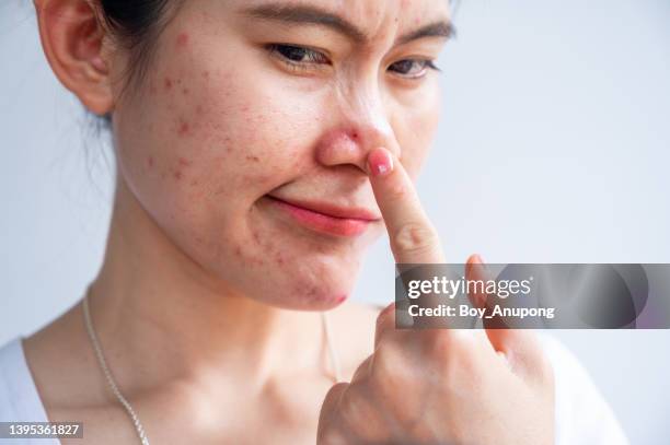 unhappy asian woman having negative feeling caused of acne occur on her face. - damaged skin stock pictures, royalty-free photos & images