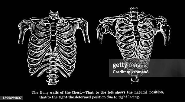 old engraved illustration of a female skeletons normal and deformed by wearing a corset - orthopedic corset stock pictures, royalty-free photos & images