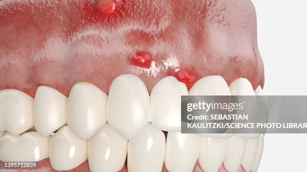 stockillustraties, clipart, cartoons en iconen met dental abscess, illustration - abces