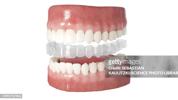clear dental aligner, illustration - invisalign stock illustrations