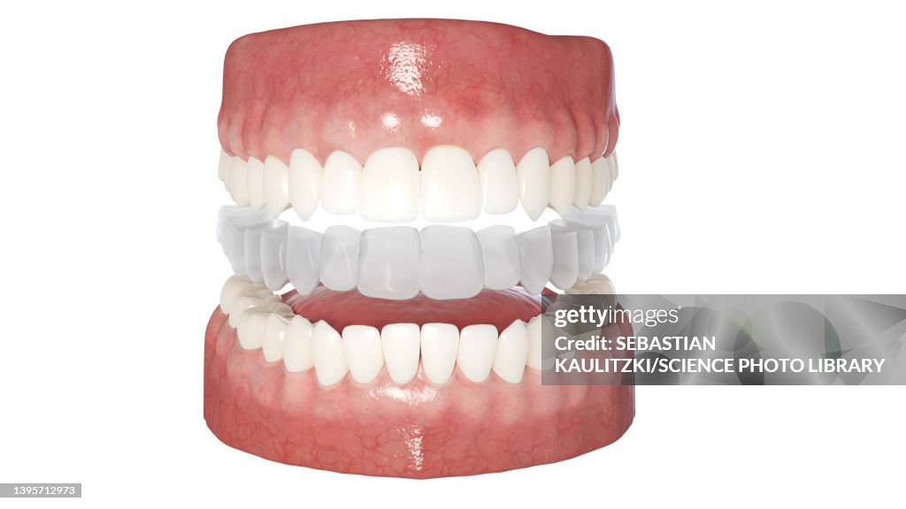 Clear dental aligner, illustration