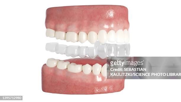 clear dental aligner, illustration - invisalign stock illustrations