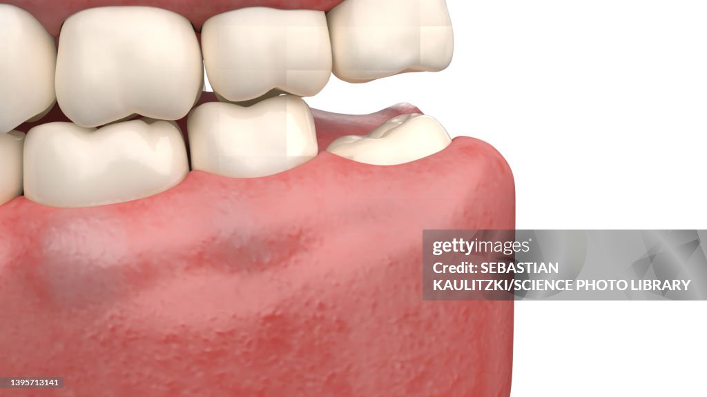 Impacted wisdom tooth, illustration